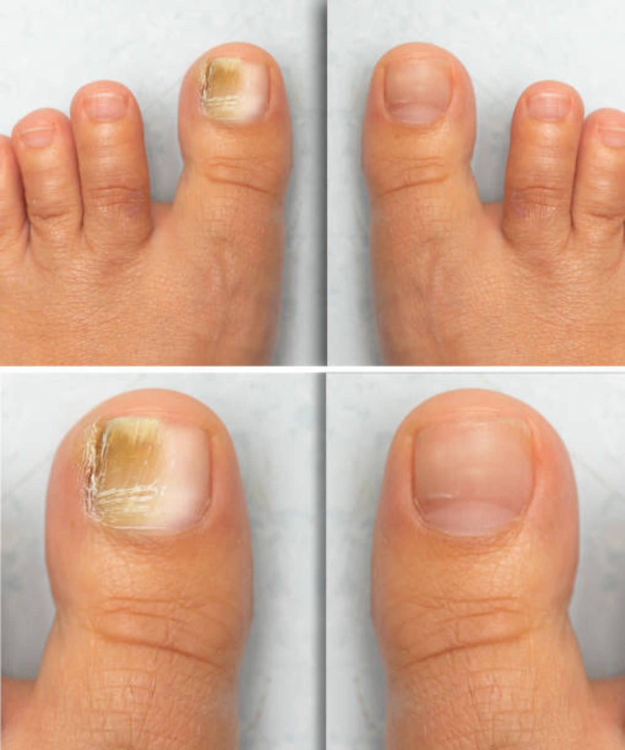 Fungal Nails guides