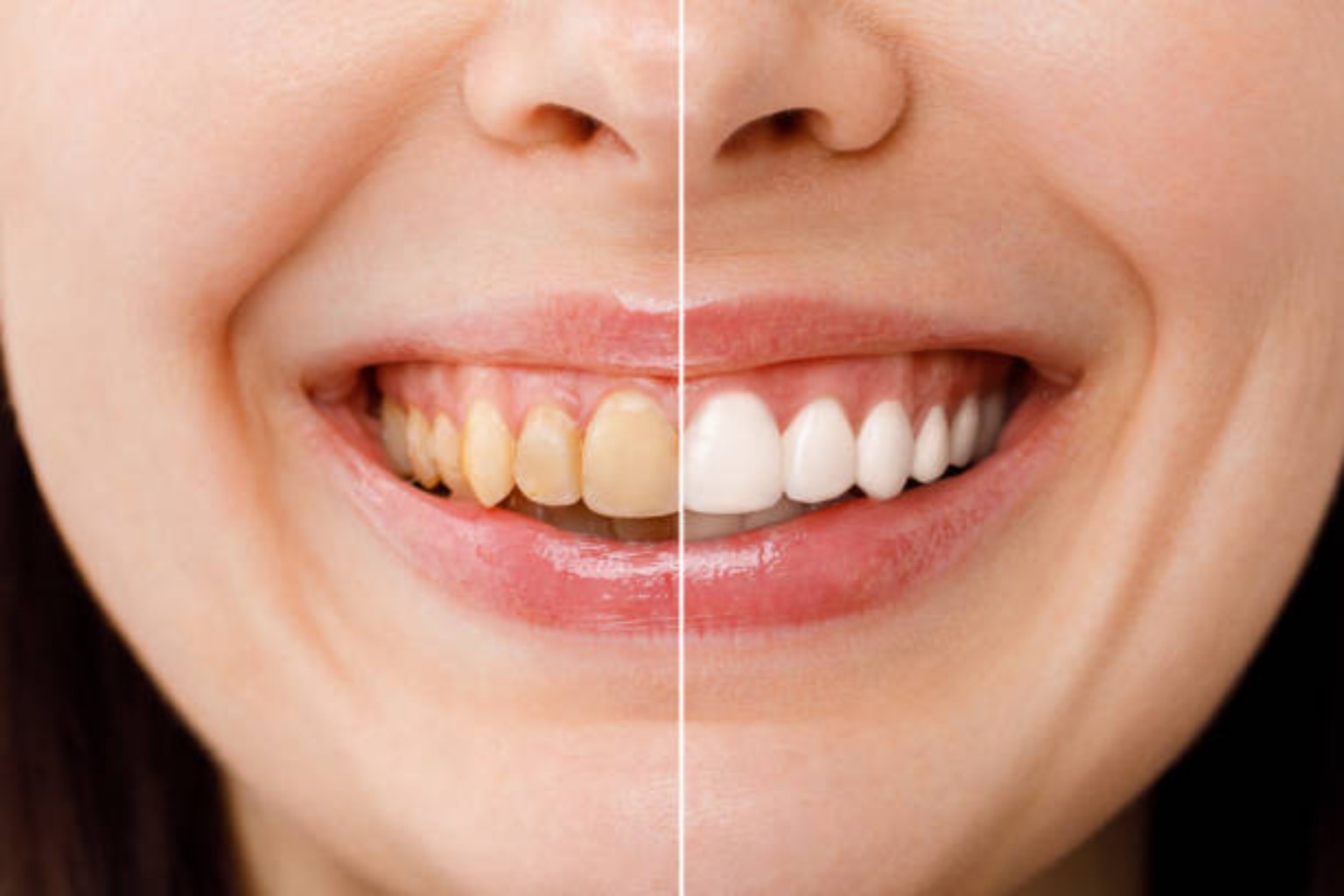 Teeth whitening